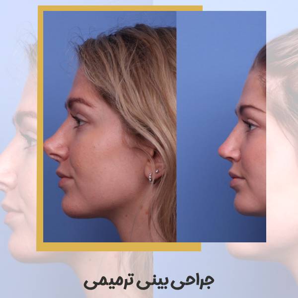 جراحی بینی ترمیمی